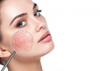 Kılcal Damar Tedavisi