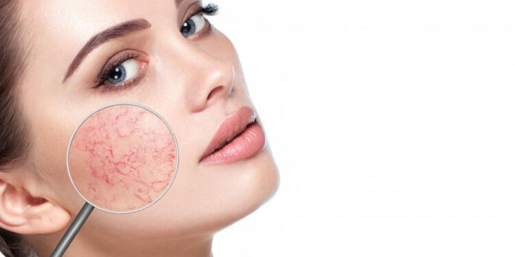 Kılcal Damar Tedavisi