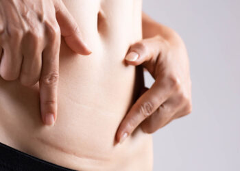 Yara İzi (Skar) Tedavisi