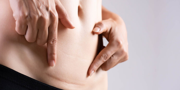 Yara İzi (Skar) Tedavisi